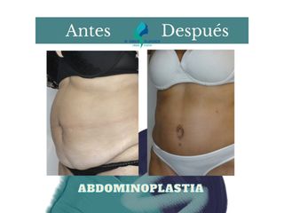 Abdominoplastia - Dr. Rodolfo Villavicencio