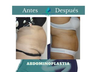 Abdominoplastia - Dr. Rodolfo Villavicencio