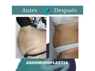 Abdominoplastia - Dr. Rodolfo Villavicencio