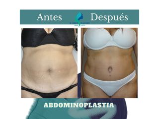 Abdominoplastia - Dr. Rodolfo Villavicencio