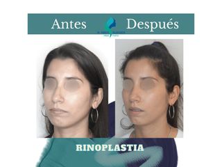 Rinoplastia - Dr. Rodolfo Villavicencio