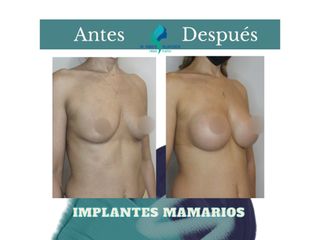 Aumento mamas - Dr. Rodolfo Villavicencio