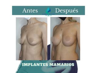 Aumento mamas - Dr. Rodolfo Villavicencio