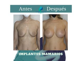 Aumento mamas - Dr. Rodolfo Villavicencio