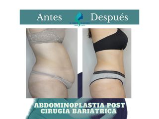 Abdominoplastia - Dr. Rodolfo Villavicencio