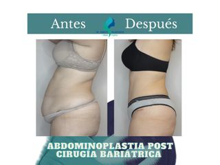 Abdominoplastia - Dr. Rodolfo Villavicencio