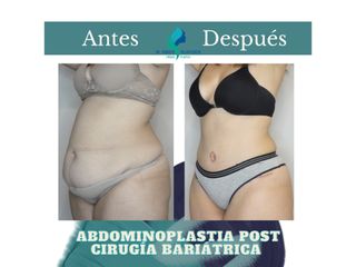 Abdominoplastia - Dr. Rodolfo Villavicencio
