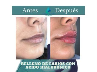Relleno de labios - Dr. Rodolfo Villavicencio