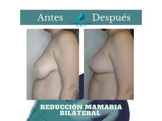 Reducción mamaria bilateral - Dr. Rodolfo Villavicencio