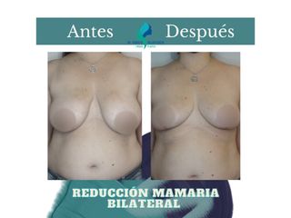 Reducción mamaria bilateral - Dr. Rodolfo Villavicencio
