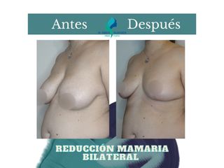 Reducción mamaria bilateral - Dr. Rodolfo Villavicencio