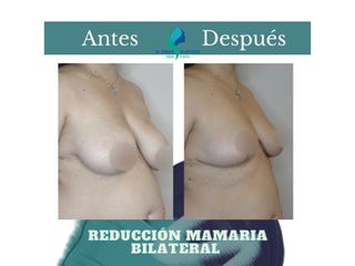 Reducción mamaria bilateral - Dr. Rodolfo Villavicencio