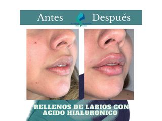 Relleno de labios - Dr. Rodolfo Villavicencio