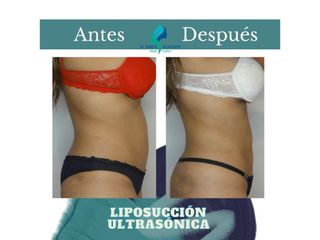 Liposucción ultrasónica - Dr. Rodolfo Villavicencio