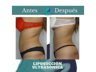 Liposucción ultrasónica - Dr. Rodolfo Villavicencio