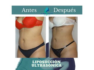 Liposucción ultrasónica - Dr. Rodolfo Villavicencio