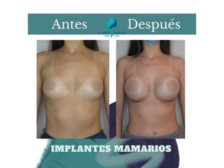 Aumento mamario - Dr. Rodolfo Villavicencio
