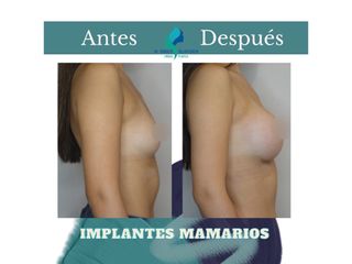 Aumento mamario - Dr. Rodolfo Villavicencio