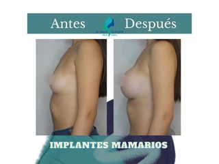 Aumento mamario - Dr. Rodolfo Villavicencio