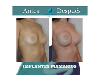 Aumento mamario - Dr. Rodolfo Villavicencio