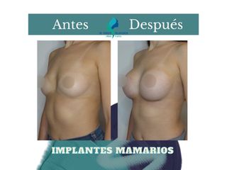 Aumento mamario - Dr. Rodolfo Villavicencio