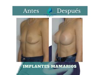 Aumento mamario - Dr. Rodolfo Villavicencio