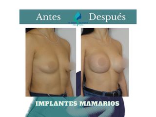 Aumento mamario - Dr. Rodolfo Villavicencio