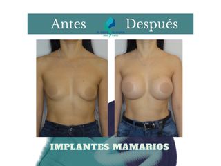 Aumento mamario - Dr. Rodolfo Villavicencio