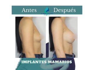Aumento mamario - Dr. Rodolfo Villavicencio