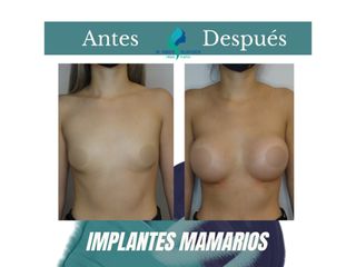 Aumento mamario - Dr. Rodolfo Villavicencio