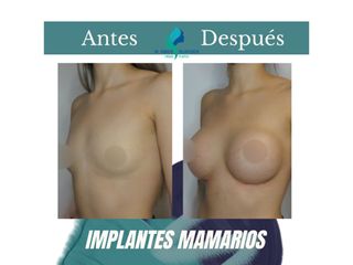 Aumento mamario - Dr. Rodolfo Villavicencio