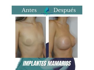 Aumento mamario - Dr. Rodolfo Villavicencio