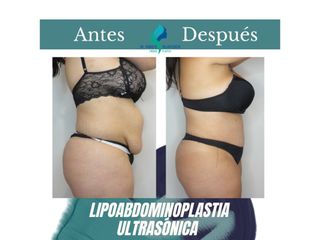 Lipoabdomindoplastia - Dr. Rodolfo Villavicencio