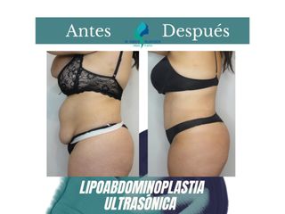 Lipoabdomindoplastia - Dr. Rodolfo Villavicencio