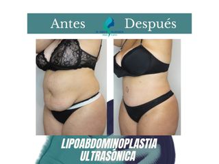 Lipoabdomindoplastia - Dr. Rodolfo Villavicencio