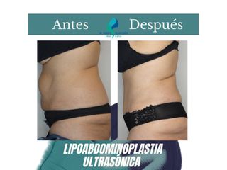 Lipoabdomindoplastia - Dr. Rodolfo Villavicencio