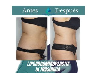Lipoabdomindoplastia - Dr. Rodolfo Villavicencio