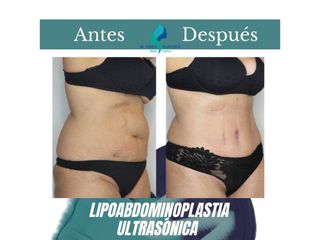 Lipoabdomindoplastia - Dr. Rodolfo Villavicencio