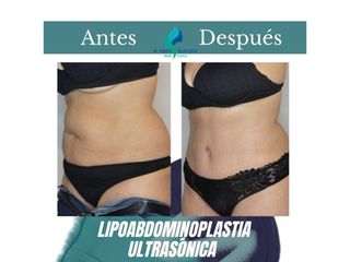 Lipoabdomindoplastia - Dr. Rodolfo Villavicencio