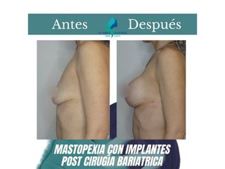 Mastopexia con implantes - Dr. Rodolfo Villavicencio