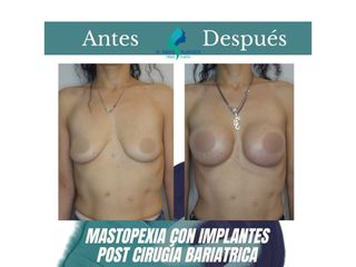 Mastopexia con implantes - Dr. Rodolfo Villavicencio