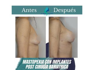 Mastopexia con implantes - Dr. Rodolfo Villavicencio