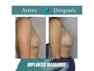 Aumento mamario - Dr. Rodolfo Villavicencio