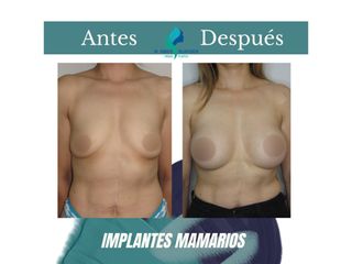 Aumento mamario - Dr. Rodolfo Villavicencio