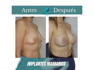 Aumento mamario - Dr. Rodolfo Villavicencio