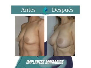 Aumento mamario - Dr. Rodolfo Villavicencio