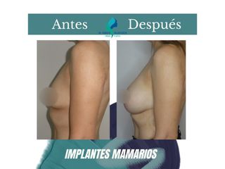 Aumento mamario - Dr. Rodolfo Villavicencio
