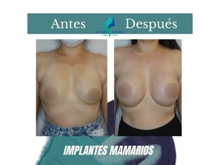 Pre y Postoperatorio de 8 meses de implantes mamarios