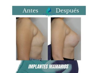 Pre y Postoperatorio de 8 meses de implantes mamarios