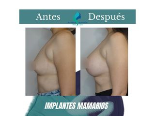 Pre y Postoperatorio de 8 meses de implantes mamarios